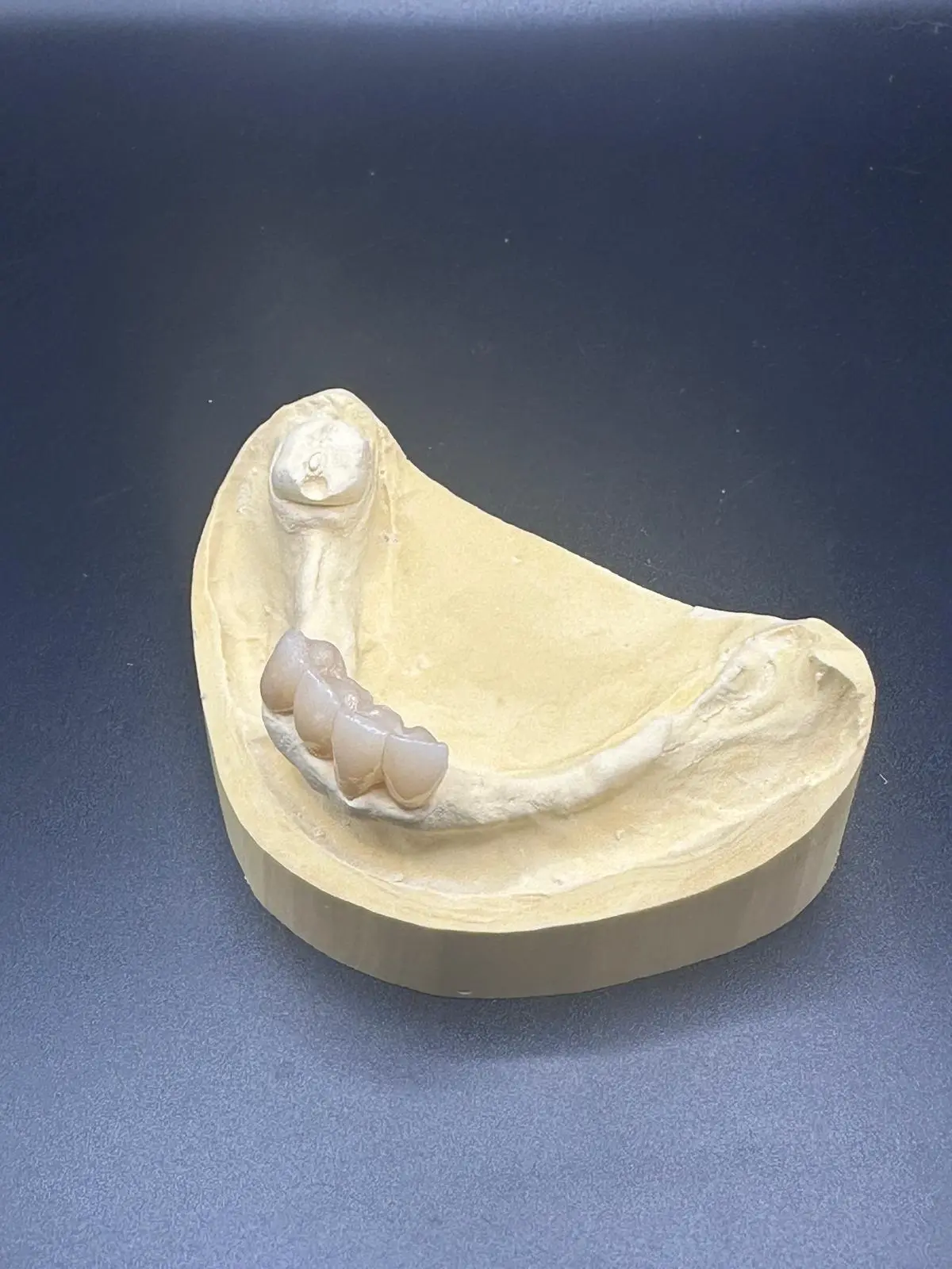 Couronne stratifiée Dental Connexion