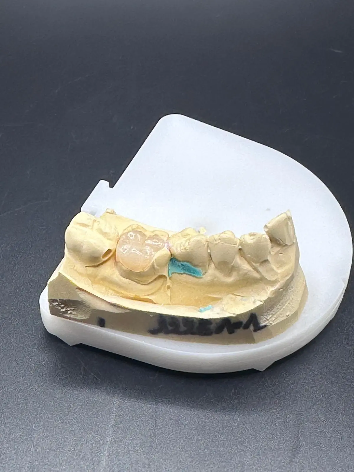 Inlay/Onlay céramique Dental Connexion
