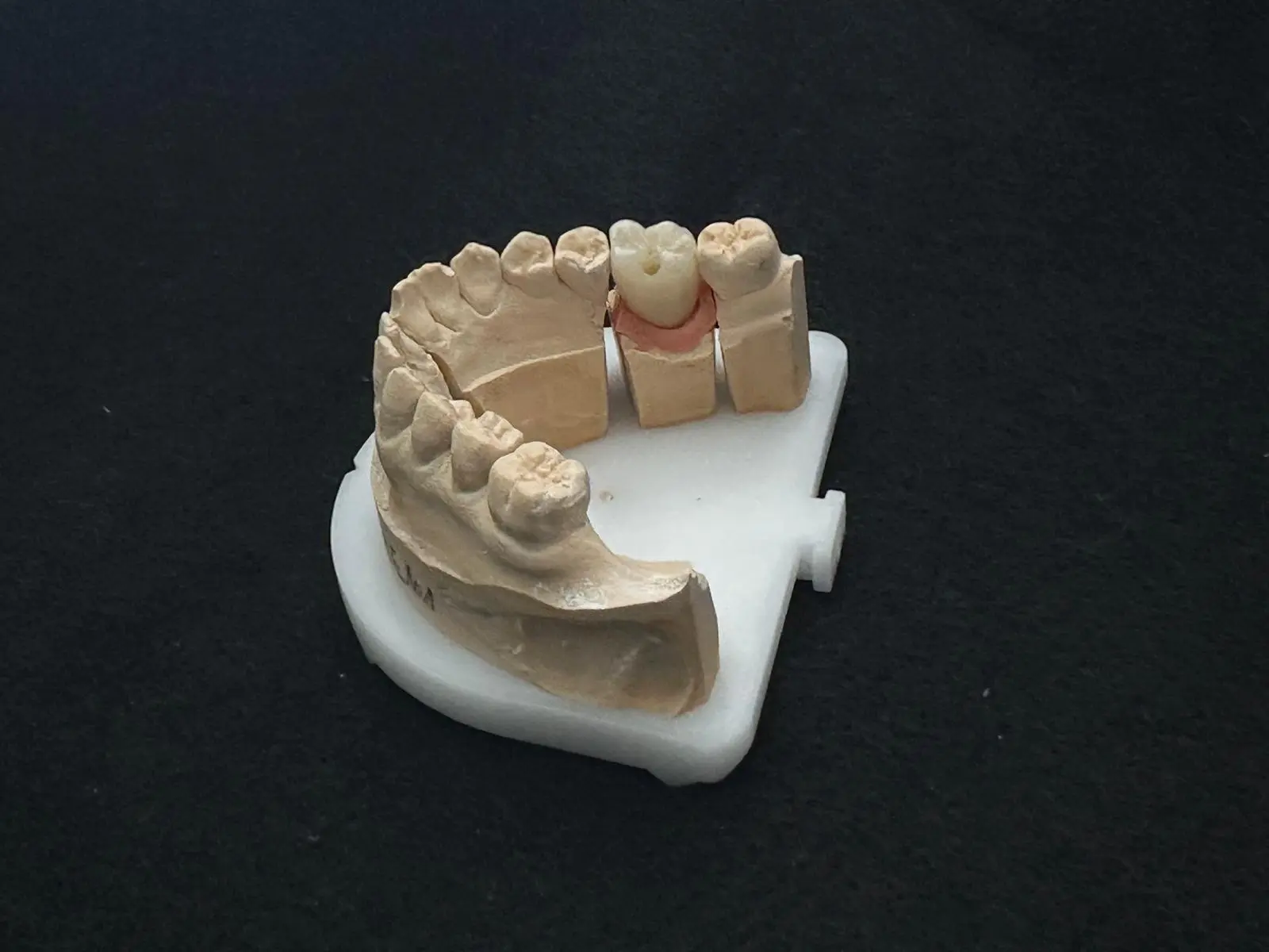 Couronne transvisée Dental Connexion