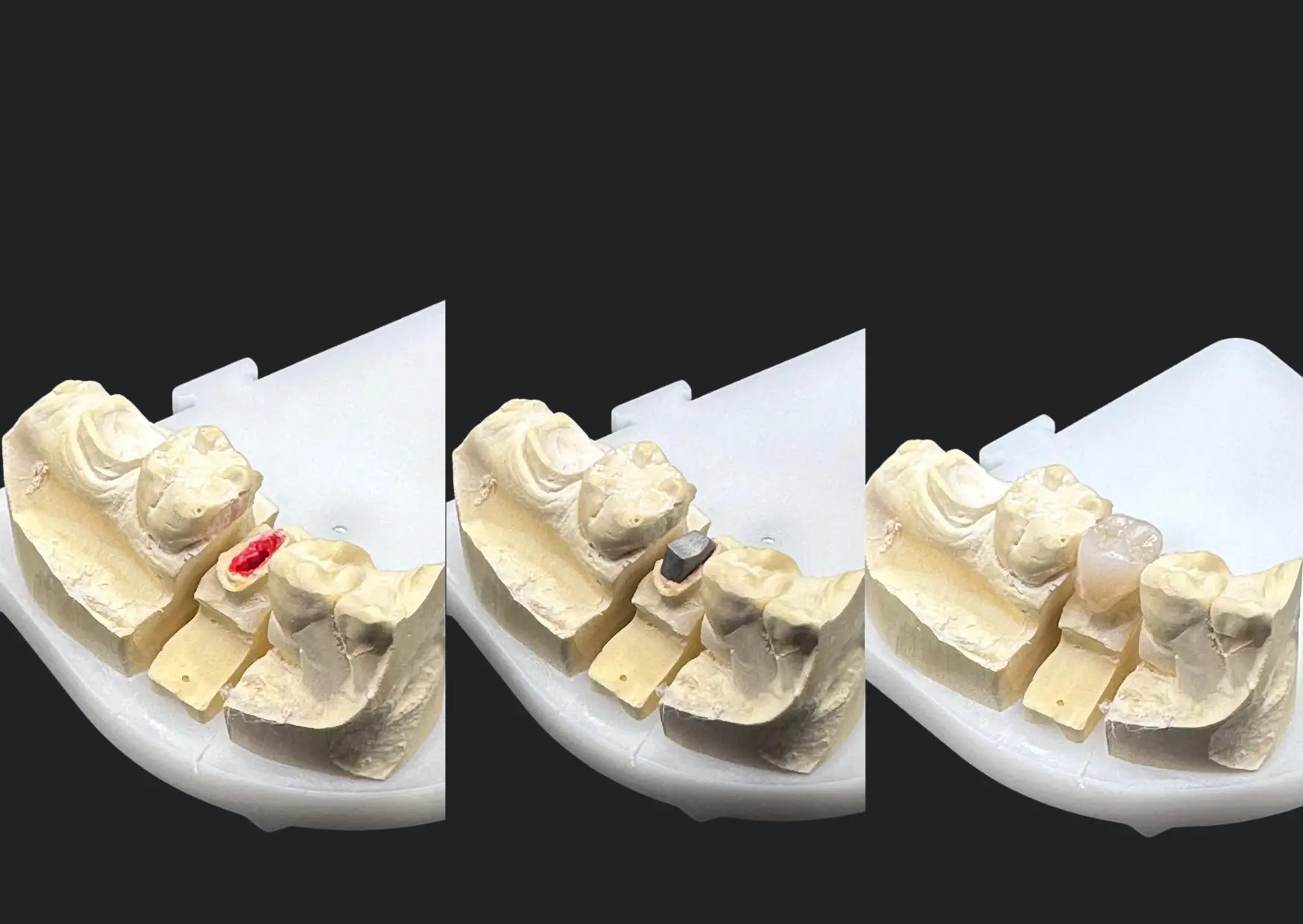Inlay Core Metallique Céramisé Dental COnnexion