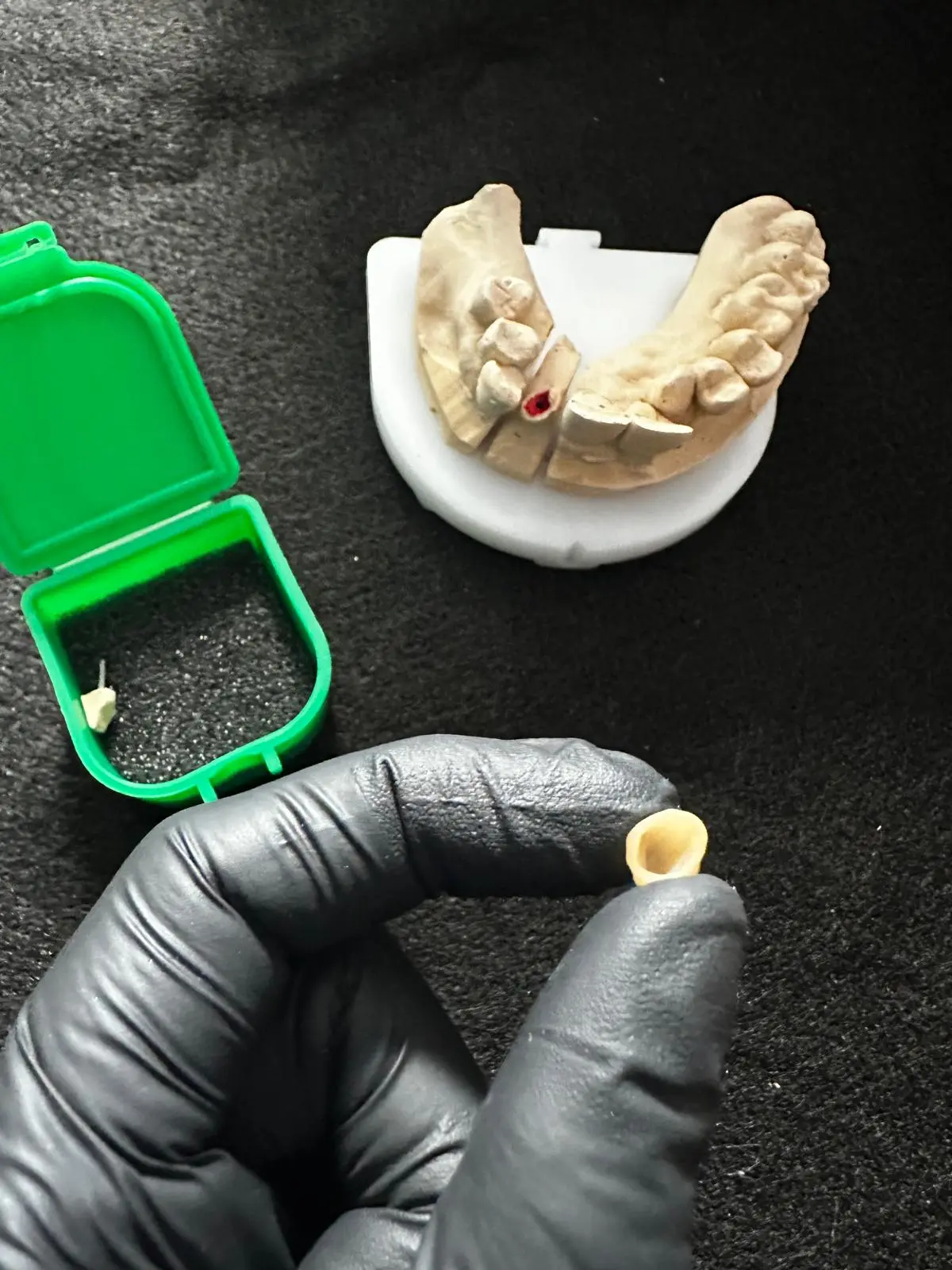 Inlay Core ceramique Dental Connexion