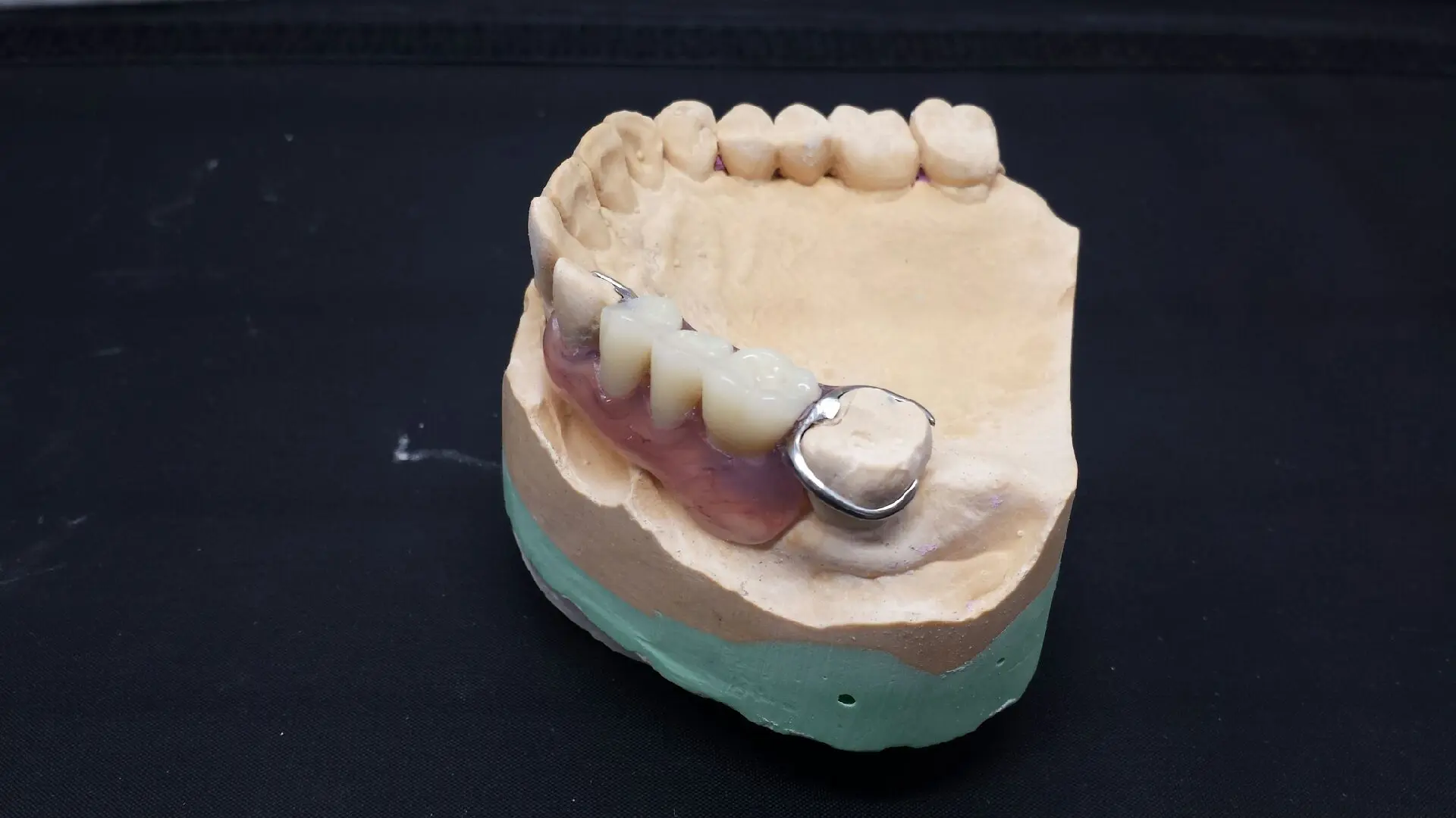 Prothèse en résine Dental Connexion 