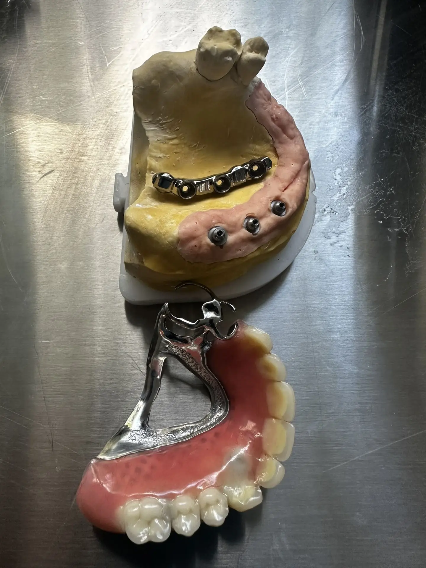 Prothèse sur attachement Dental Connexion